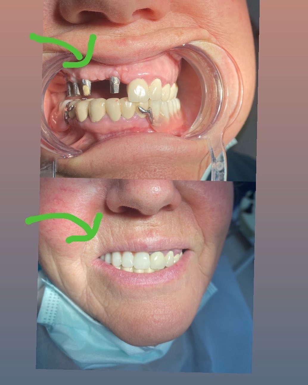 Kanal Tedavisi (Endodonti)